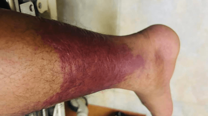 रविलाई सेलुलाइटिसको समस्या, कति गम्भीर ?